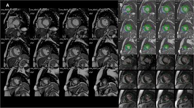 Multi-Modality Imaging for the Identification of Arrhythmogenic Substrates Prior to Electrophysiology Studies